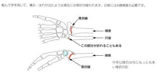 橈骨遠位端骨折2