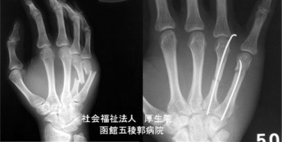 手指の骨折