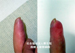 指尖部損傷後の指変形