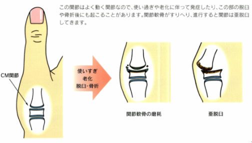 関節リウマチ