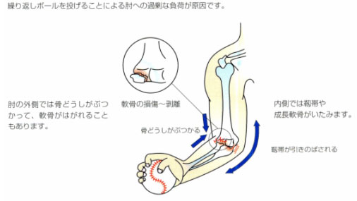 野球肘