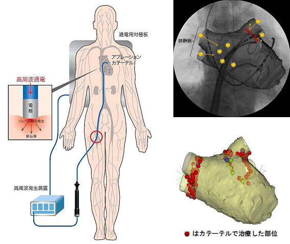 アビ レーション 手術