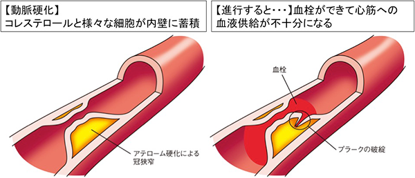 動脈硬化