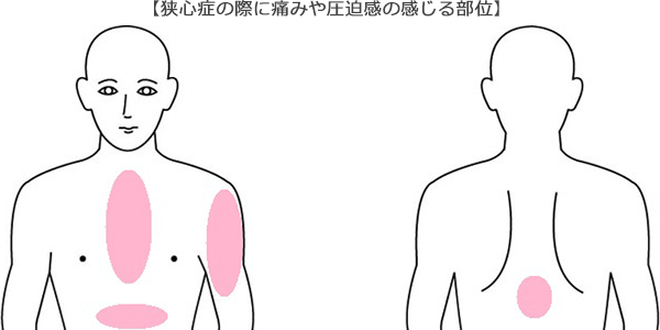 狭心症の際に痛みや圧迫感の感じる部位