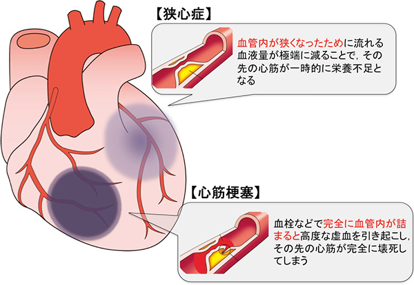 狭心症と心筋梗塞