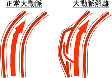 正常大動脈と大動脈解離