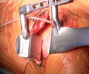 MICS CABG専用器具にて手術施行