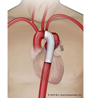 胸部大動脈瘤ステントグラフト内挿術2