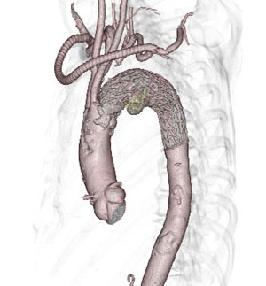 胸部大動脈瘤ステントグラフト内挿術3