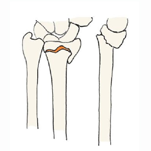 橈骨遠位端骨折
