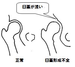 臼蓋形成不全