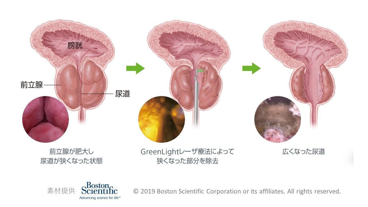 アルファブロッカー