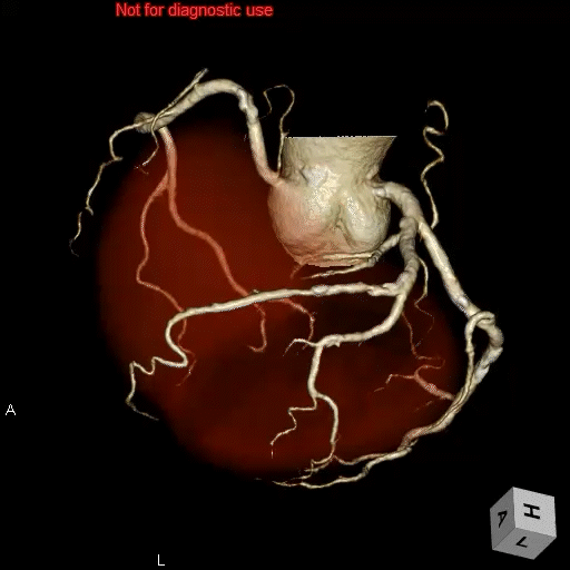 心臓3D-2