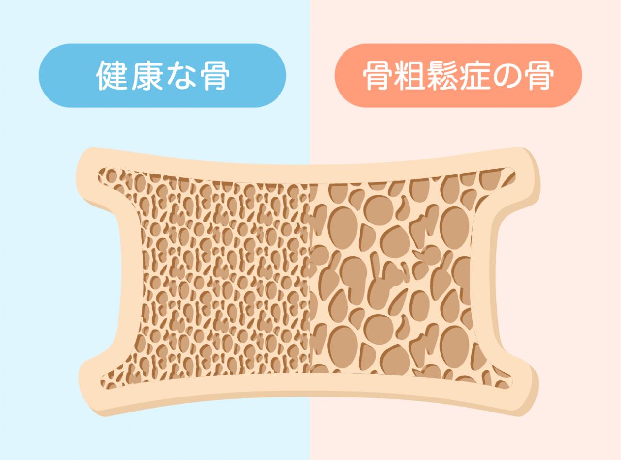 骨粗鬆症 治っ た人 いま すか